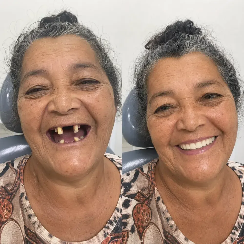 Paciente da Odonto Centter antes e depois de recuperar os dentes superiores com dentes fixos