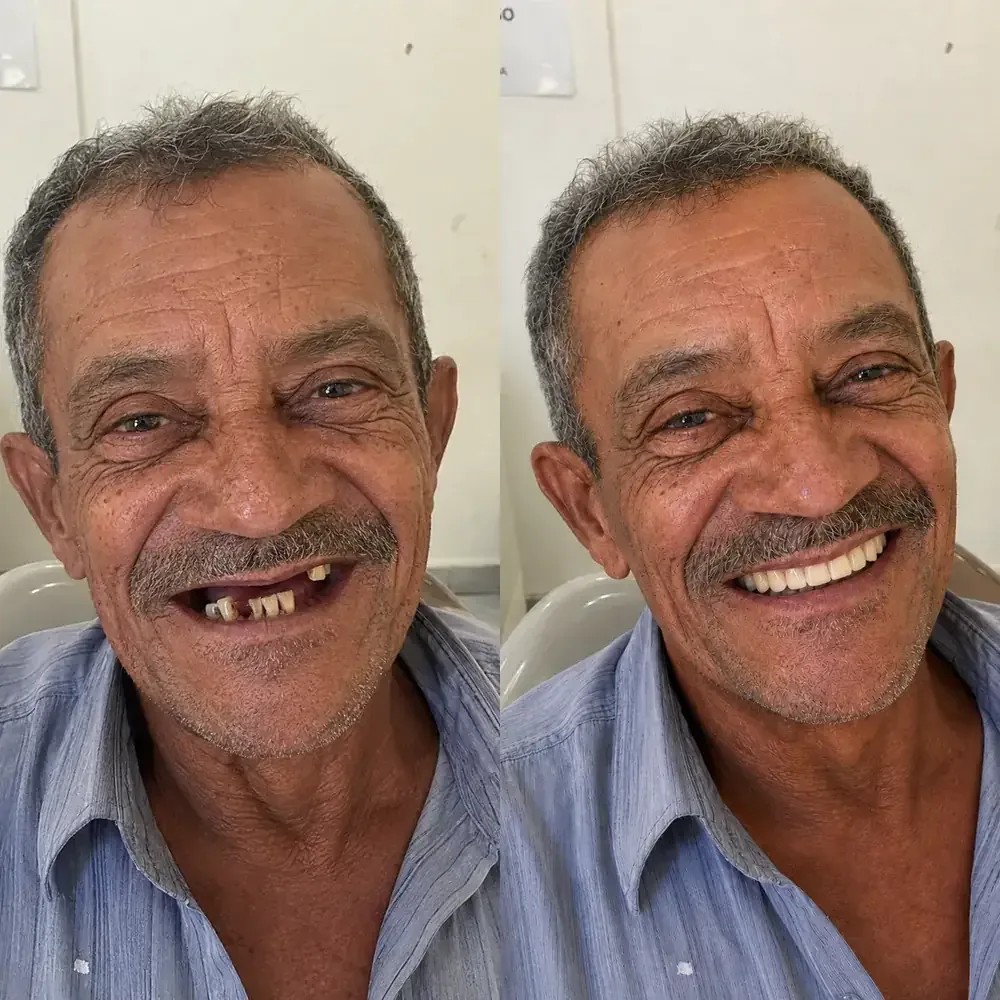 Paciente da Odonto Centter antes e depois da reabilitação do sorriso com dentes fixos