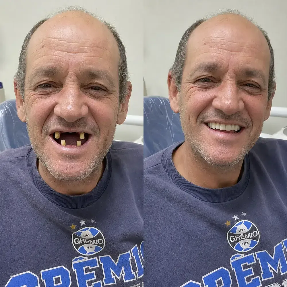 Paciente da Odonto Centter antes e depois de voltar a sorrir com dentes fixos