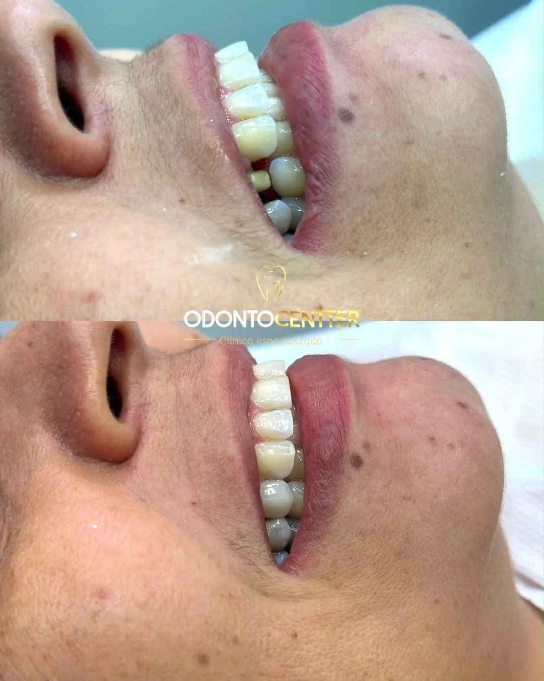 Paciente da Odonto Centter antes e depois da reabilitação do sorriso com dentes fixos